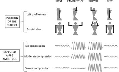 Relationship Between Inflow Impairment and Skin <mark class="highlighted">Oxygen Availability</mark> to the Upper Limb During Standardized Arm Abduction in Patients With Suspected Thoracic Outlet Syndrome